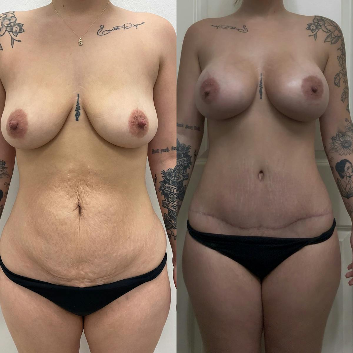 Tummy Tuck Before & After Gallery - Patient 320546 - Image 1