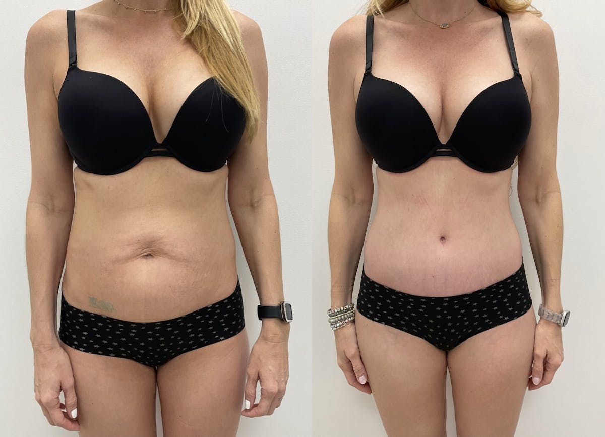 Tummy Tuck Before & After Gallery - Patient 192067 - Image 1