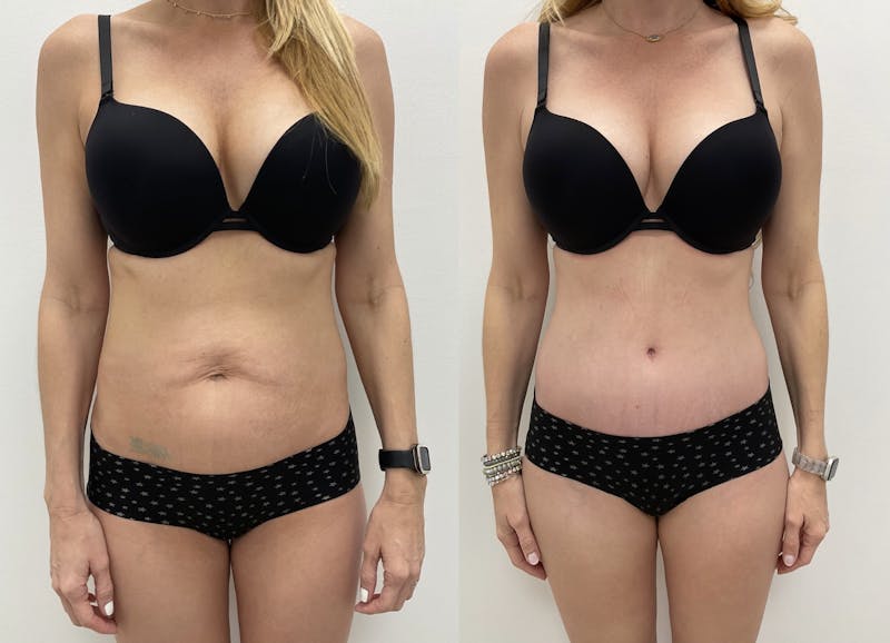 Tummy Tuck Before & After Gallery - Patient 192067 - Image 1