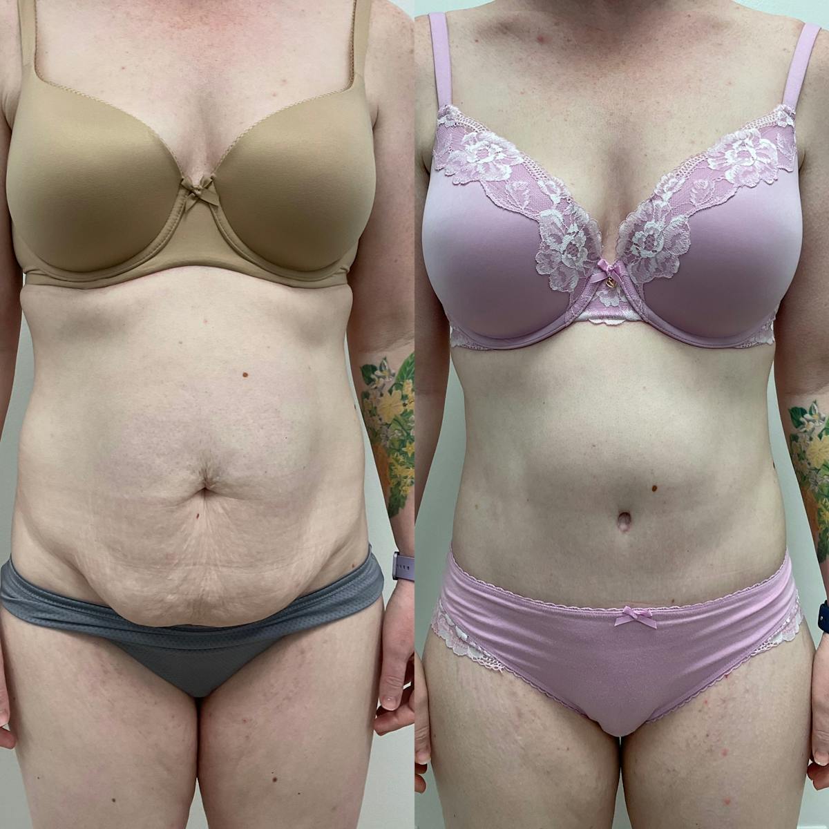 Tummy Tuck Before & After Gallery - Patient 201966 - Image 1