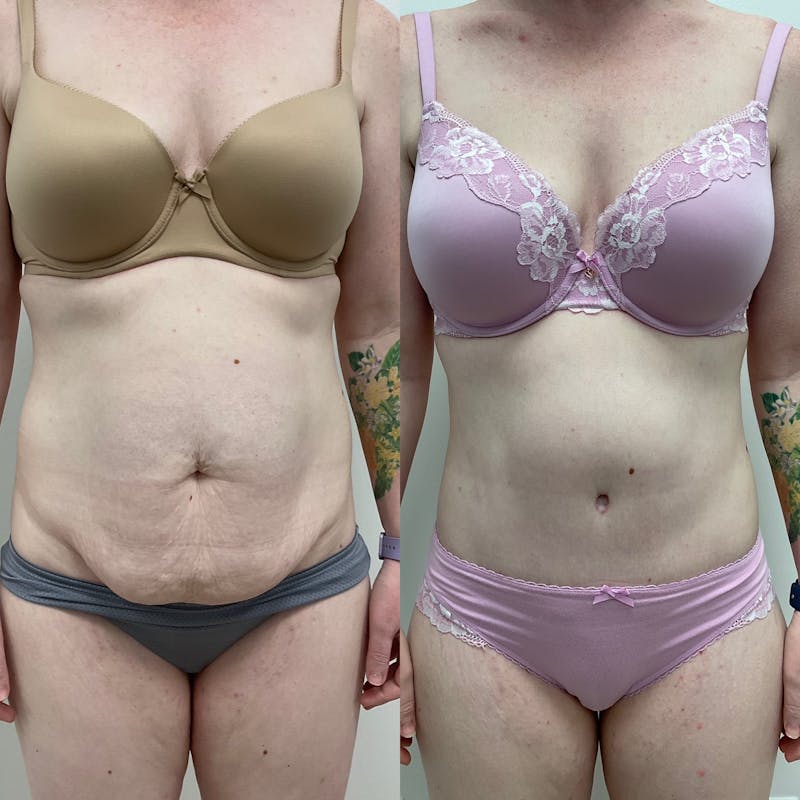 Tummy Tuck Before & After Gallery - Patient 201966 - Image 1