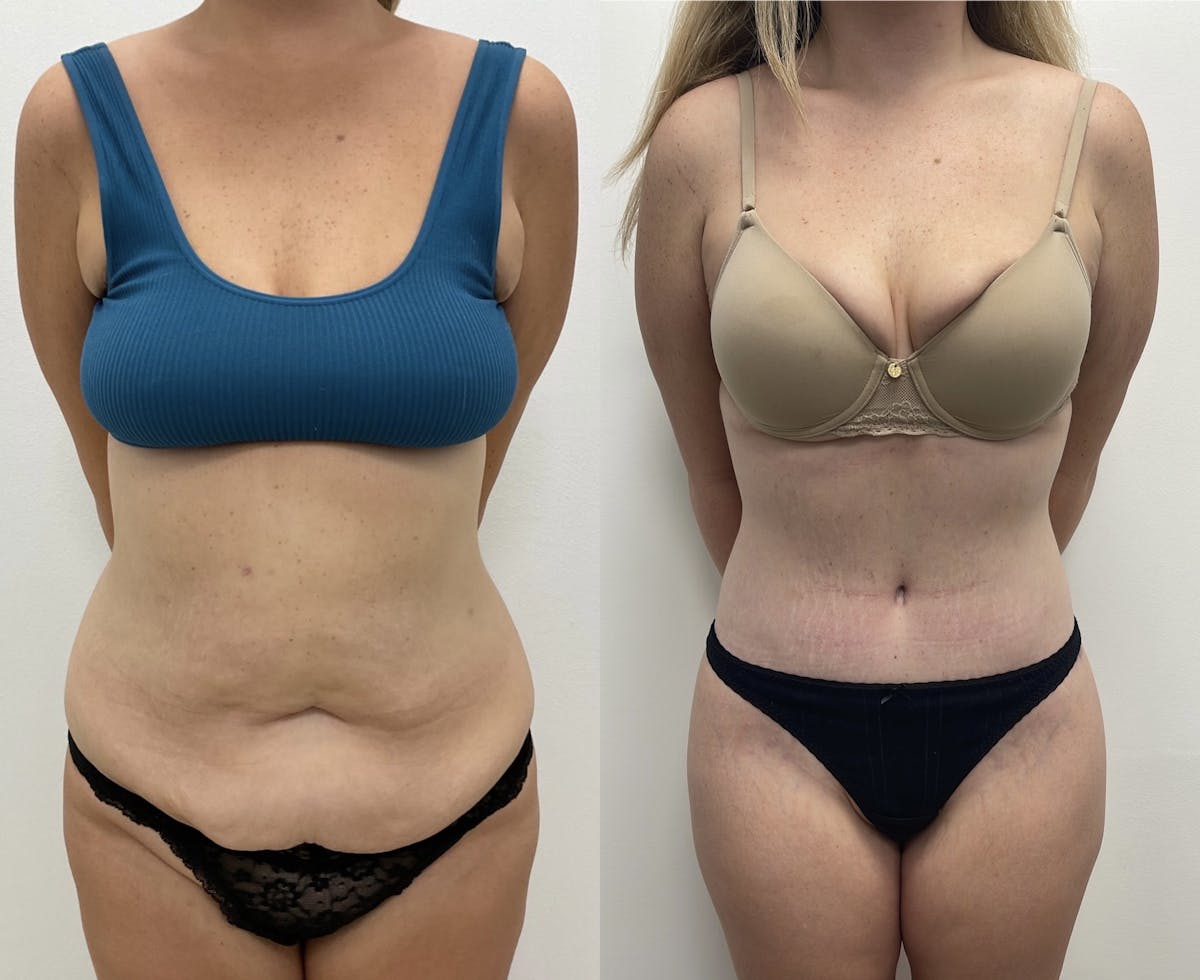 Tummy Tuck Before & After Gallery - Patient 134720 - Image 1