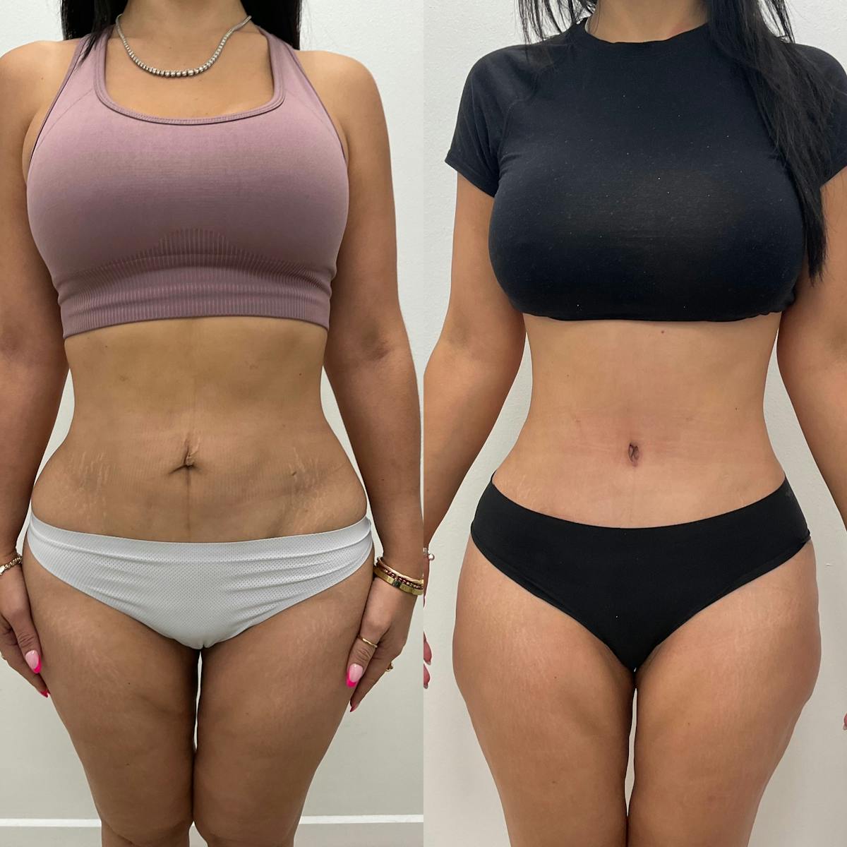 Tummy Tuck Before & After Gallery - Patient 207251 - Image 1