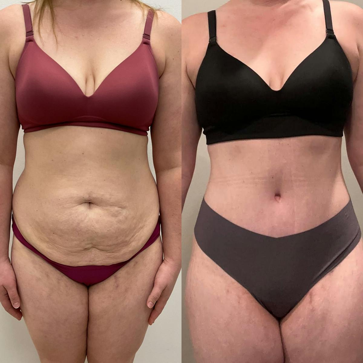 Tummy Tuck Before & After Gallery - Patient 118325 - Image 1