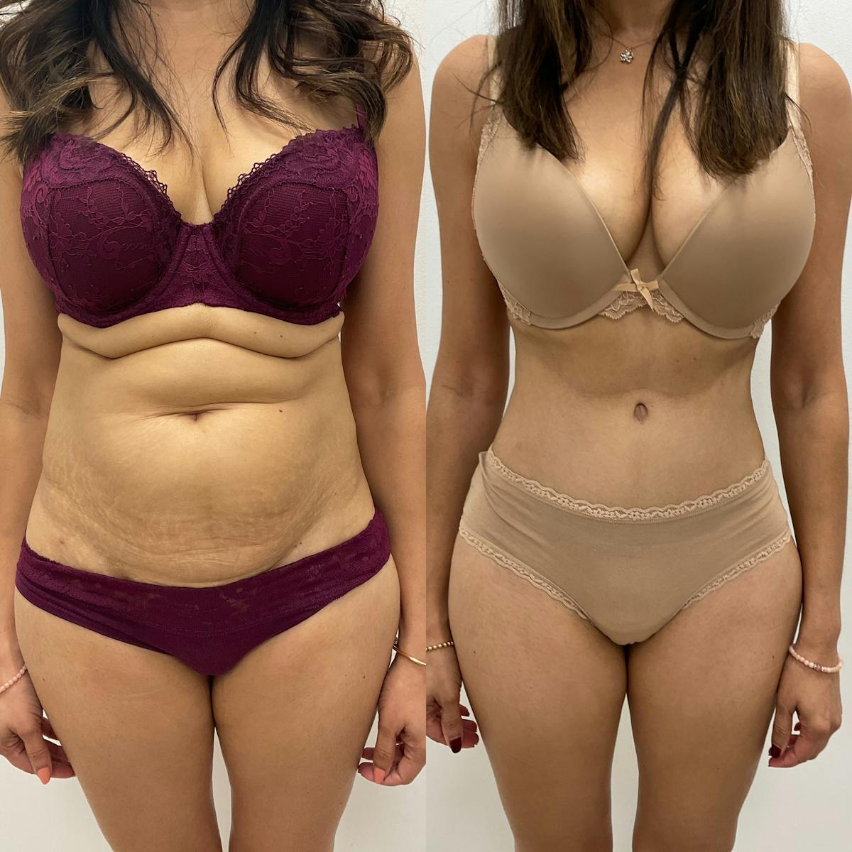 Tummy Tuck Before & After Gallery - Patient 888562 - Image 1