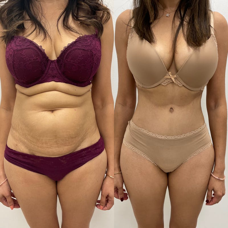 Tummy Tuck Before & After Gallery - Patient 888562 - Image 1