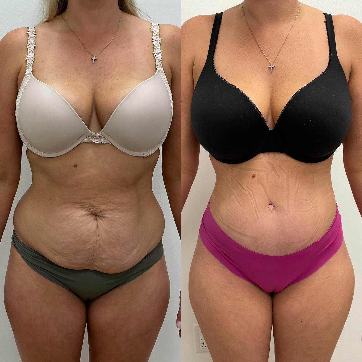 Tummy Tuck Before & After Gallery - Patient 238218 - Image 1