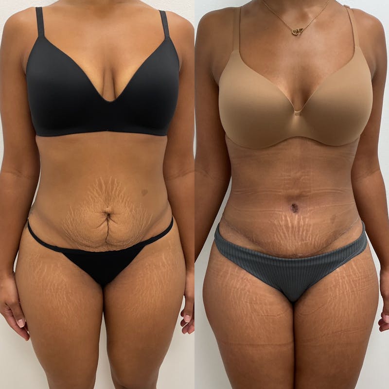 Tummy Tuck Before & After Gallery - Patient 363556 - Image 1