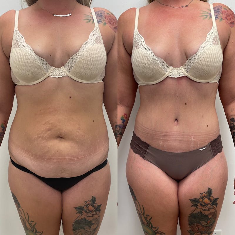 Tummy Tuck Before & After Gallery - Patient 302797 - Image 1