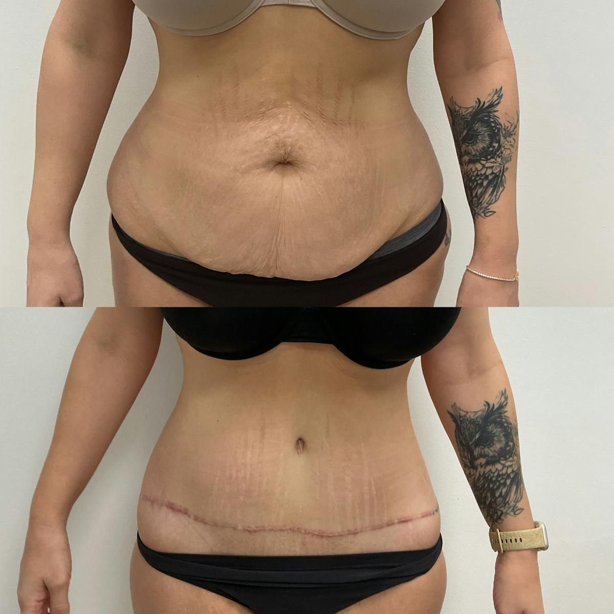 Tummy Tuck Before & After Gallery - Patient 794466 - Image 1