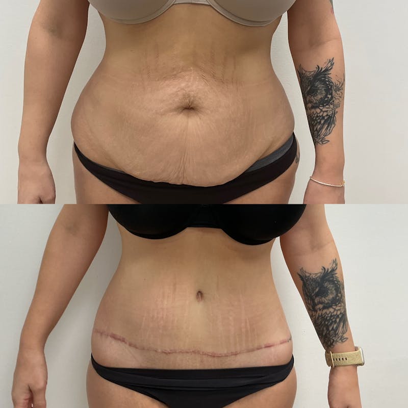 Tummy Tuck Before & After Gallery - Patient 794466 - Image 1