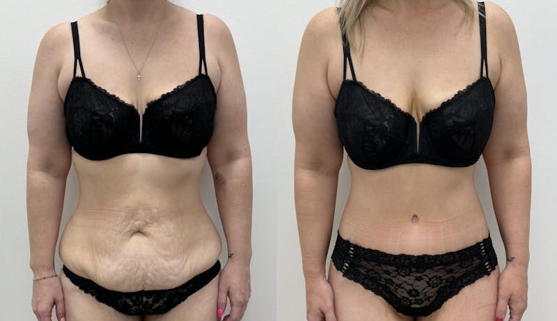 Tummy Tuck Before & After Gallery - Patient 295306 - Image 1