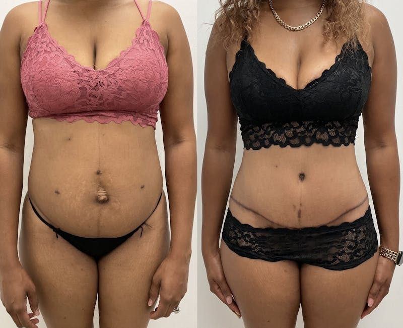 Tummy Tuck Before & After Gallery - Patient 302356 - Image 1