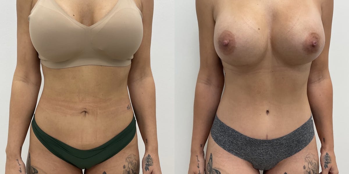Tummy Tuck Before & After Gallery - Patient 161270 - Image 1