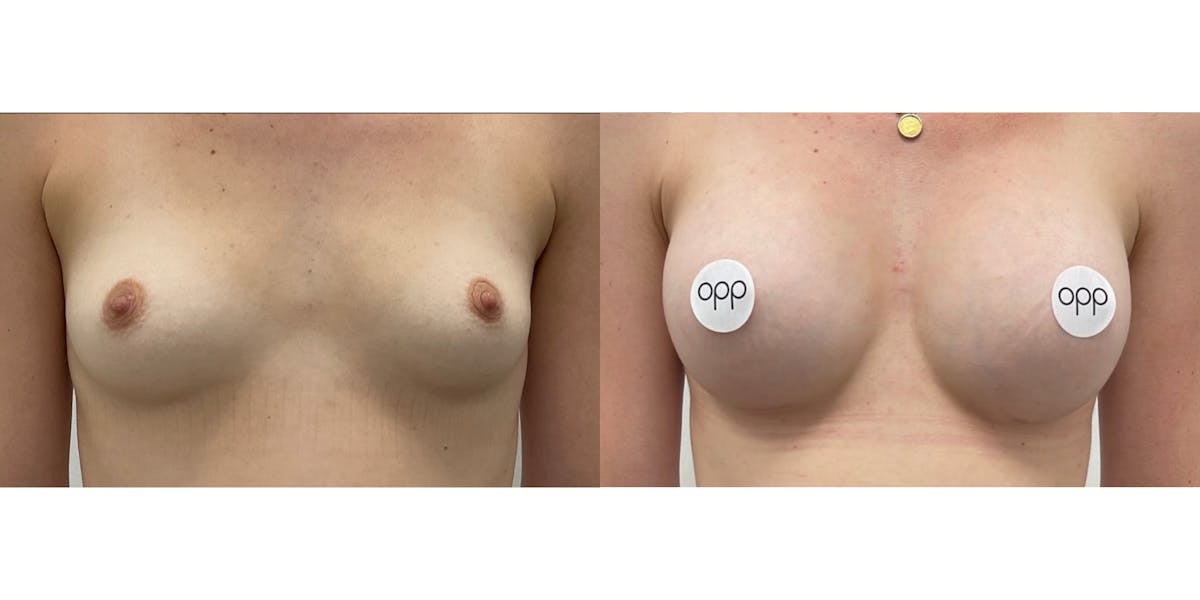Breast Augmentation Before & After Gallery - Patient 734720 - Image 1