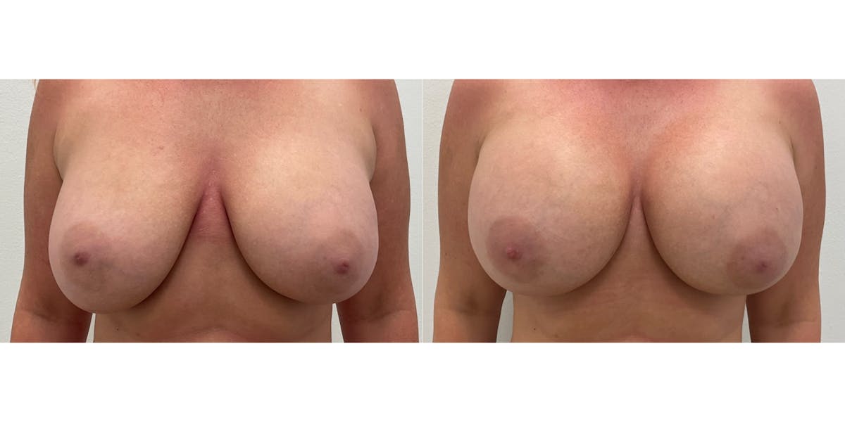Breast Augmentation Before & After Gallery - Patient 346309 - Image 1