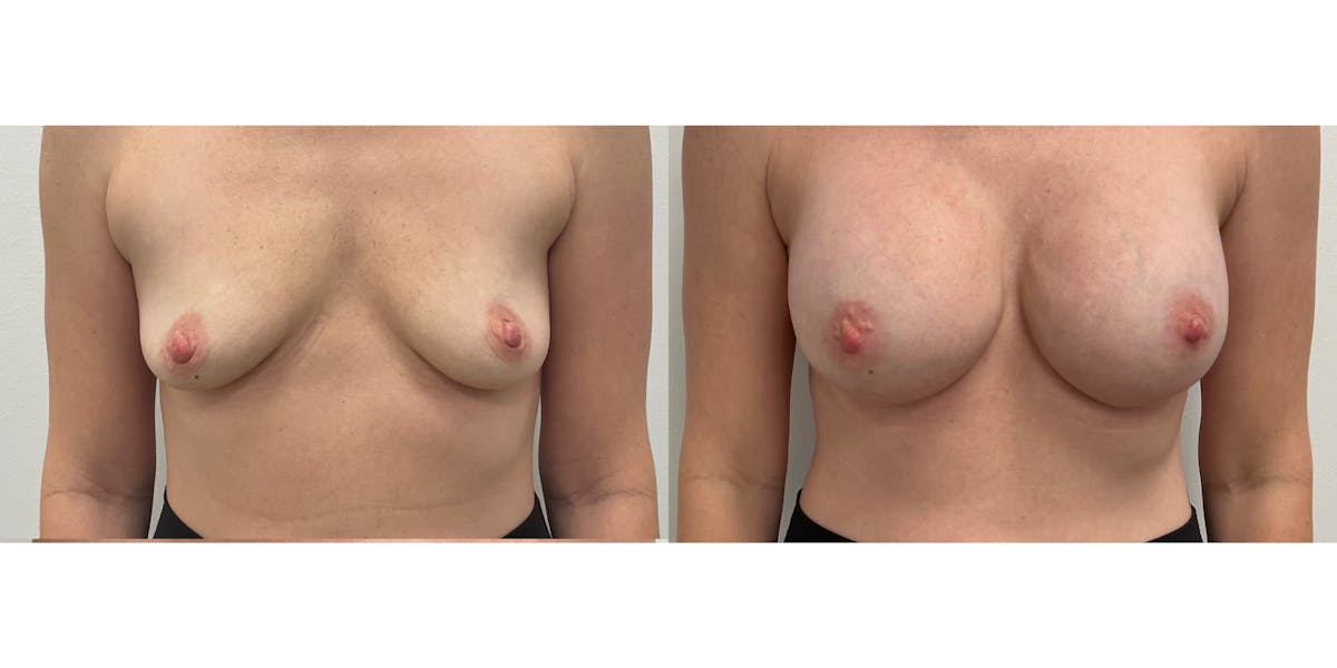 Breast Augmentation Before & After Gallery - Patient 348355 - Image 1