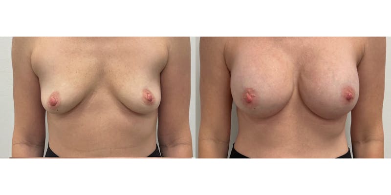 Breast Augmentation Before & After Gallery - Patient 348355 - Image 1