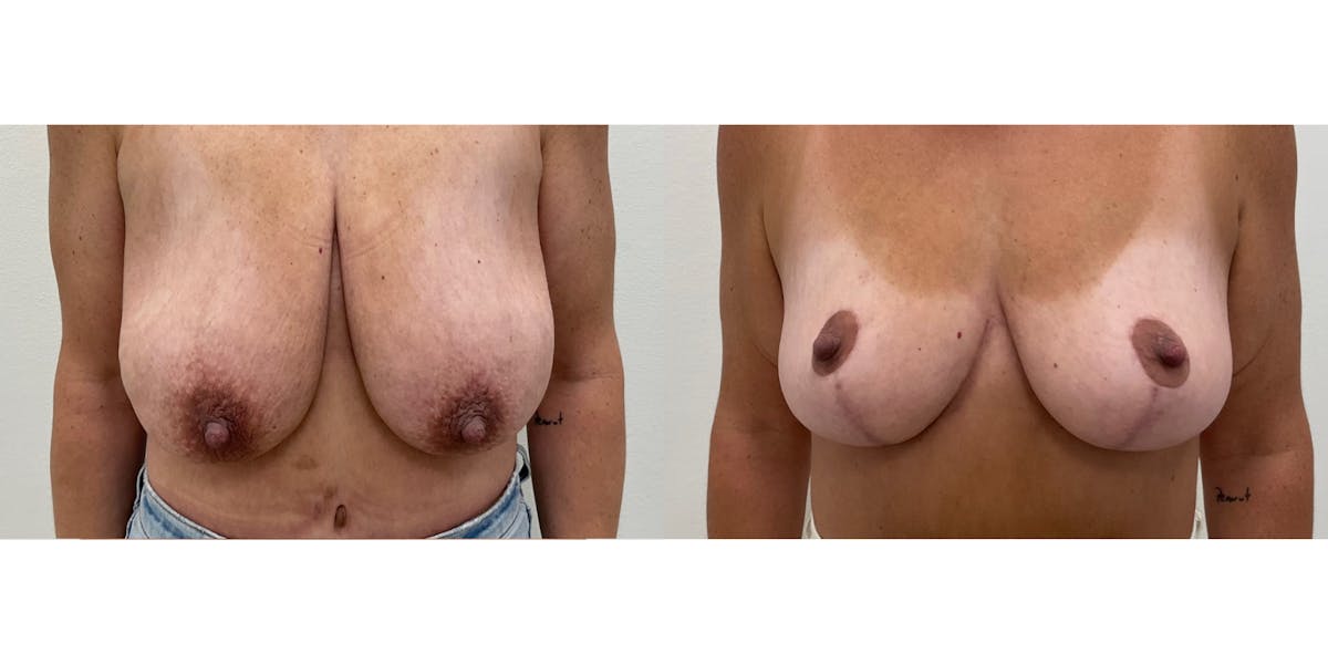 Breast Augmentation Before & After Gallery - Patient 337096 - Image 1