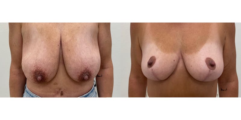 Breast Augmentation Before & After Gallery - Patient 337096 - Image 1