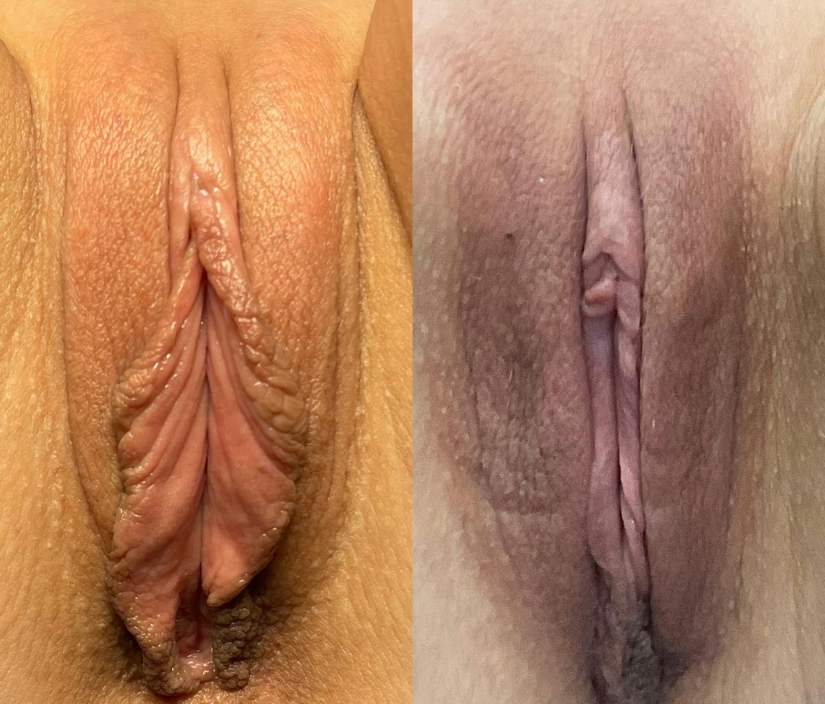 Labiaplasty Before & After Gallery - Patient 185816 - Image 1