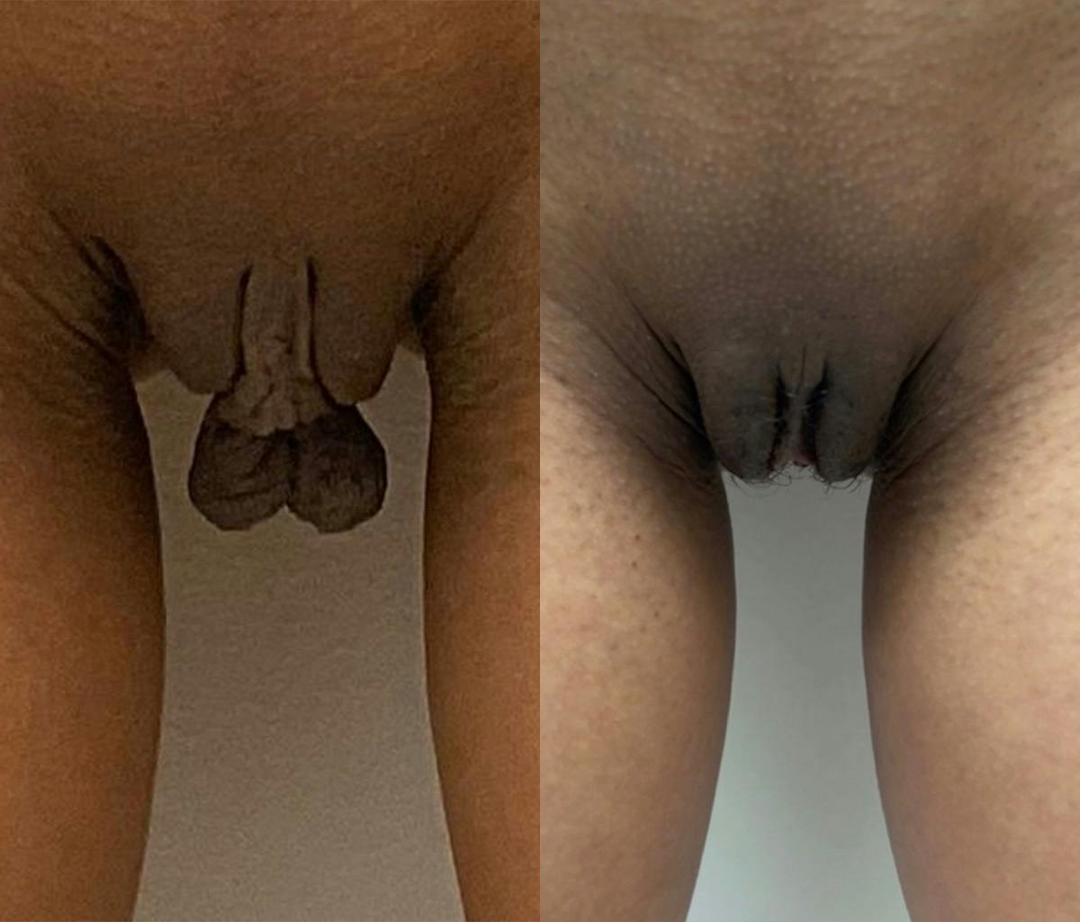 Labiaplasty Before & After Gallery - Patient 410880 - Image 2