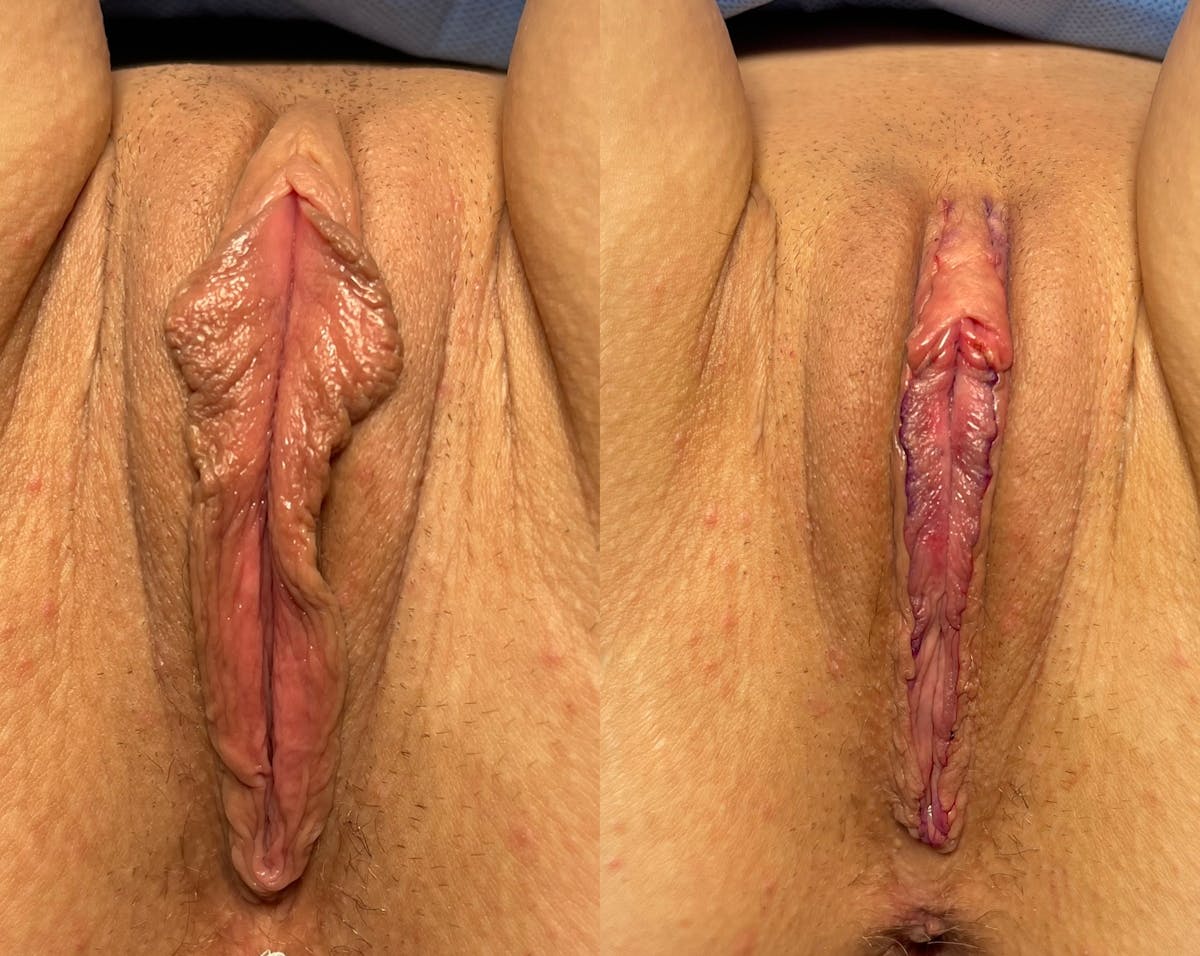 Labiaplasty Before & After Gallery - Patient 371244 - Image 1