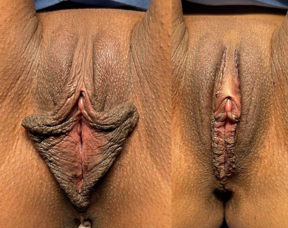 Labiaplasty Before & After Gallery - Patient 173420 - Image 1
