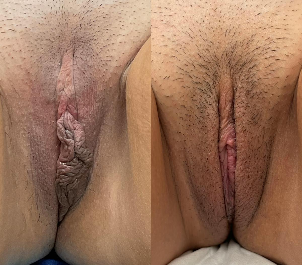 Labiaplasty Before & After Gallery - Patient 221939 - Image 1
