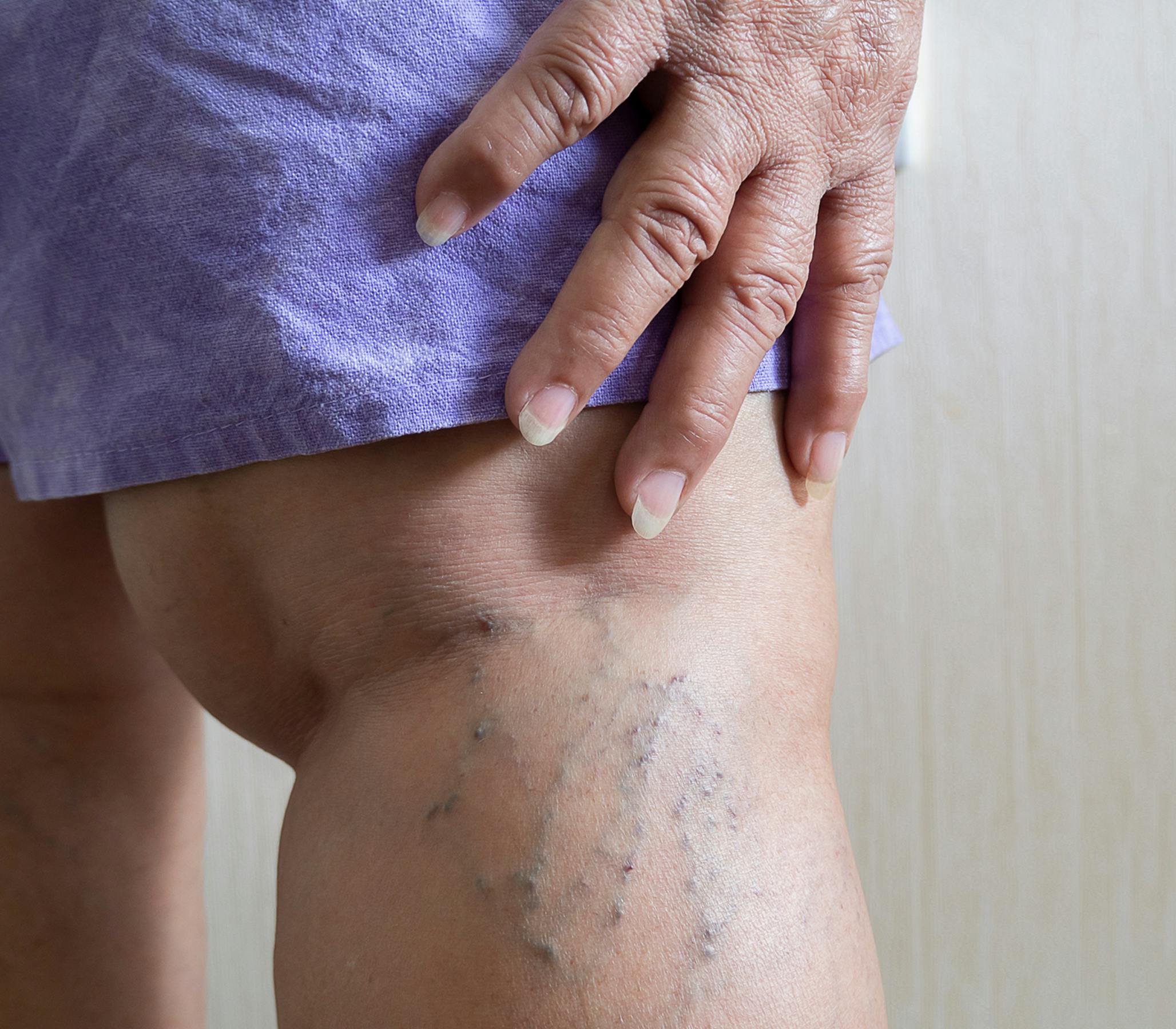 back of ladys thigh with phlebectomy