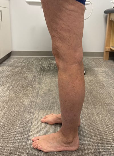 Radio Frequency Ablation Treatment Before & After Gallery - Patient 282834 - Image 2