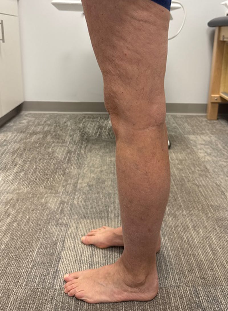 Radio Frequency Ablation Treatment Before & After Gallery - Patient 282834 - Image 2