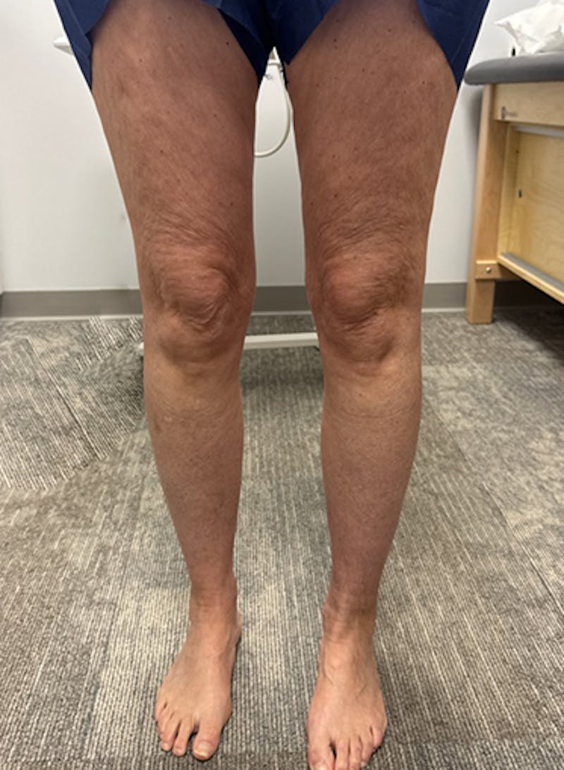 Radio Frequency Ablation Treatment Before & After Gallery - Patient 282834 - Image 4