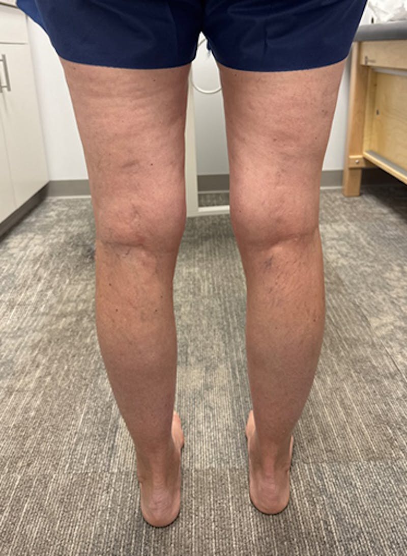 Radio Frequency Ablation Treatment Before & After Gallery - Patient 282834 - Image 6