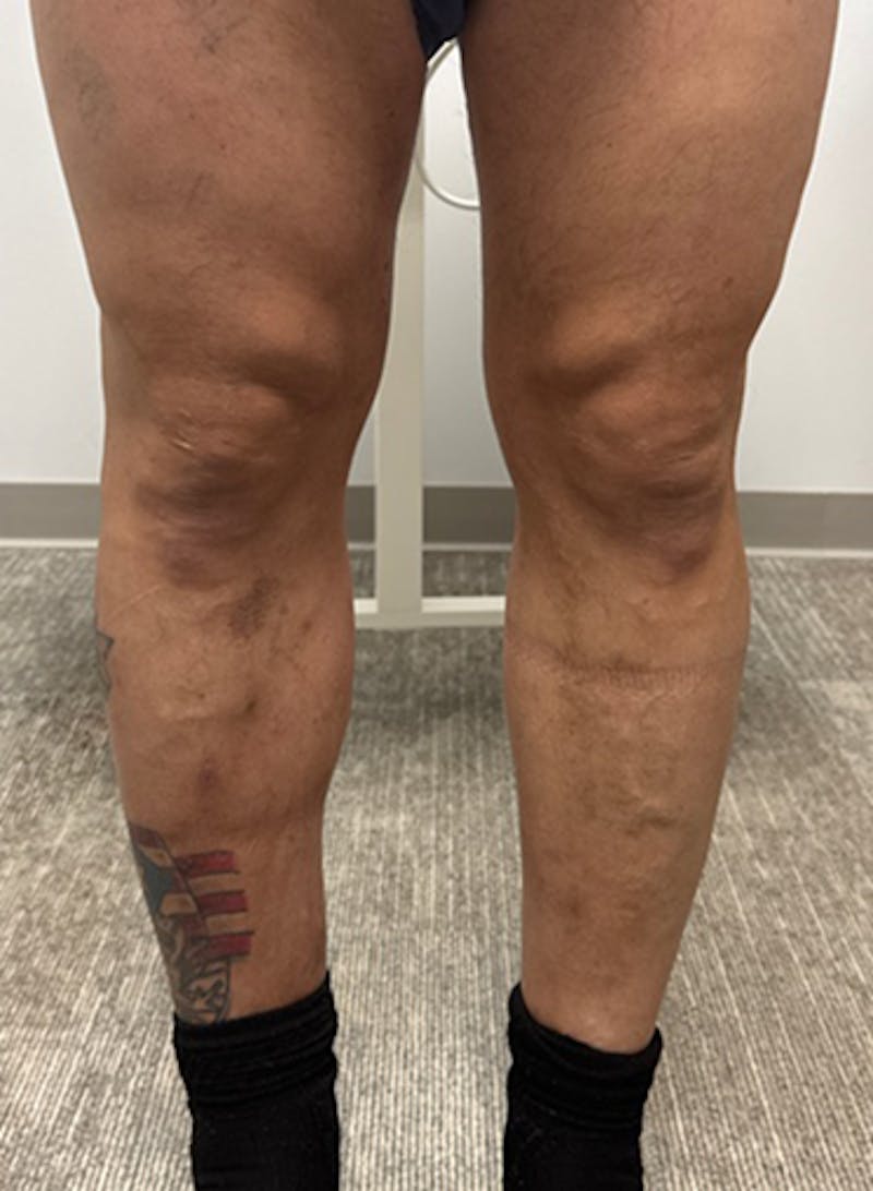 Varithena Treatment Before & After Gallery - Patient 325442 - Image 2
