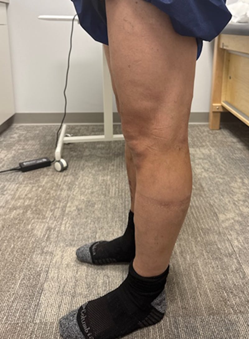 Varithena Treatment Before & After Gallery - Patient 325442 - Image 4