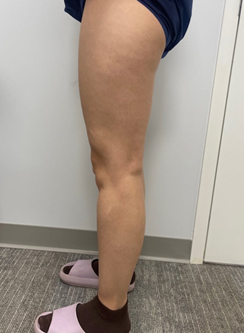 Varithena Treatment Before & After Gallery - Patient 128046 - Image 4