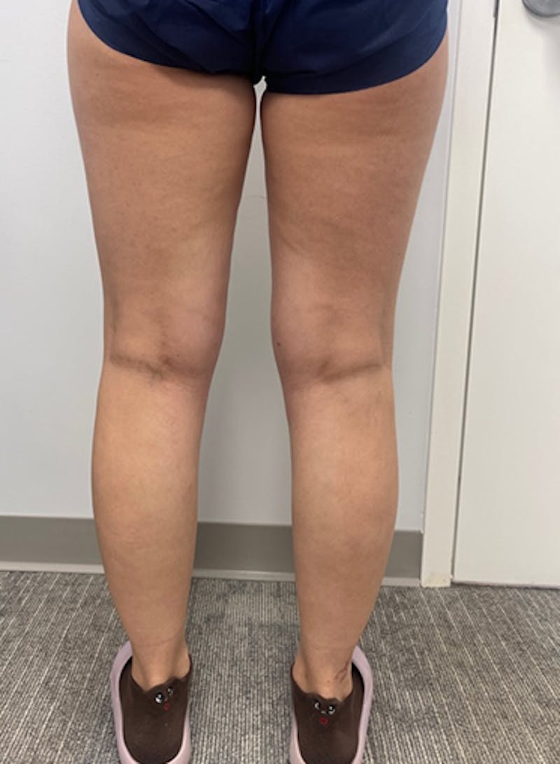 Varithena Treatment Before & After Gallery - Patient 128046 - Image 6