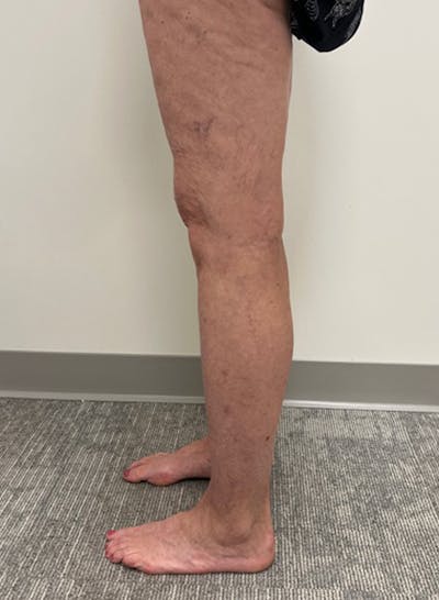 Radio Frequency Ablation Treatment Before & After Gallery - Patient 282834 - Image 1