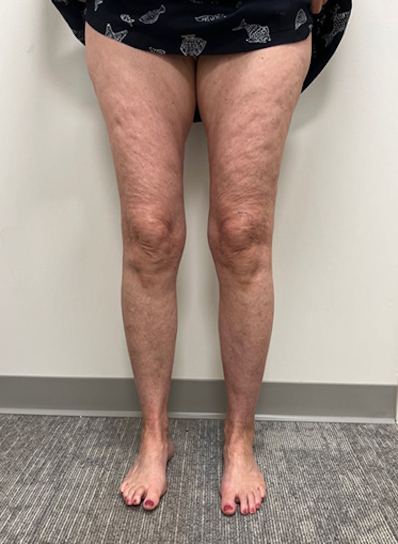 Radio Frequency Ablation Treatment Before & After Gallery - Patient 282834 - Image 3