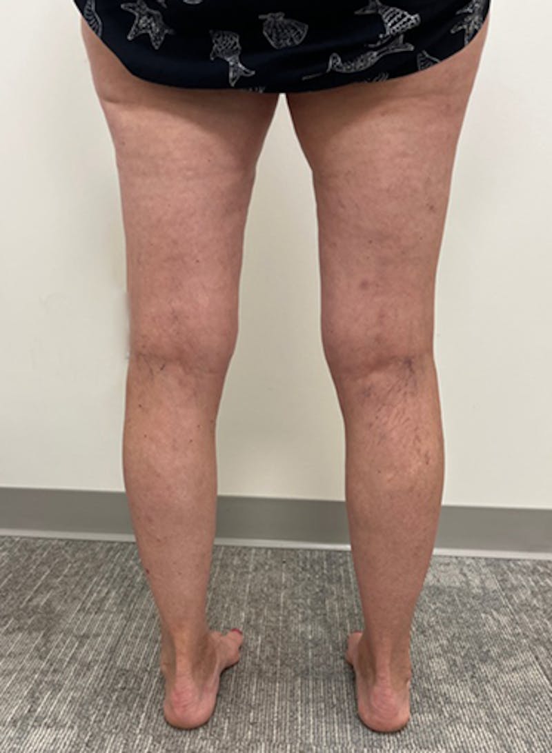 Radio Frequency Ablation Treatment Before & After Gallery - Patient 282834 - Image 5