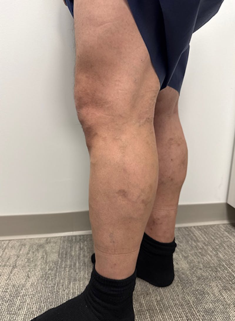 Varithena Treatment Before & After Gallery - Patient 325442 - Image 3