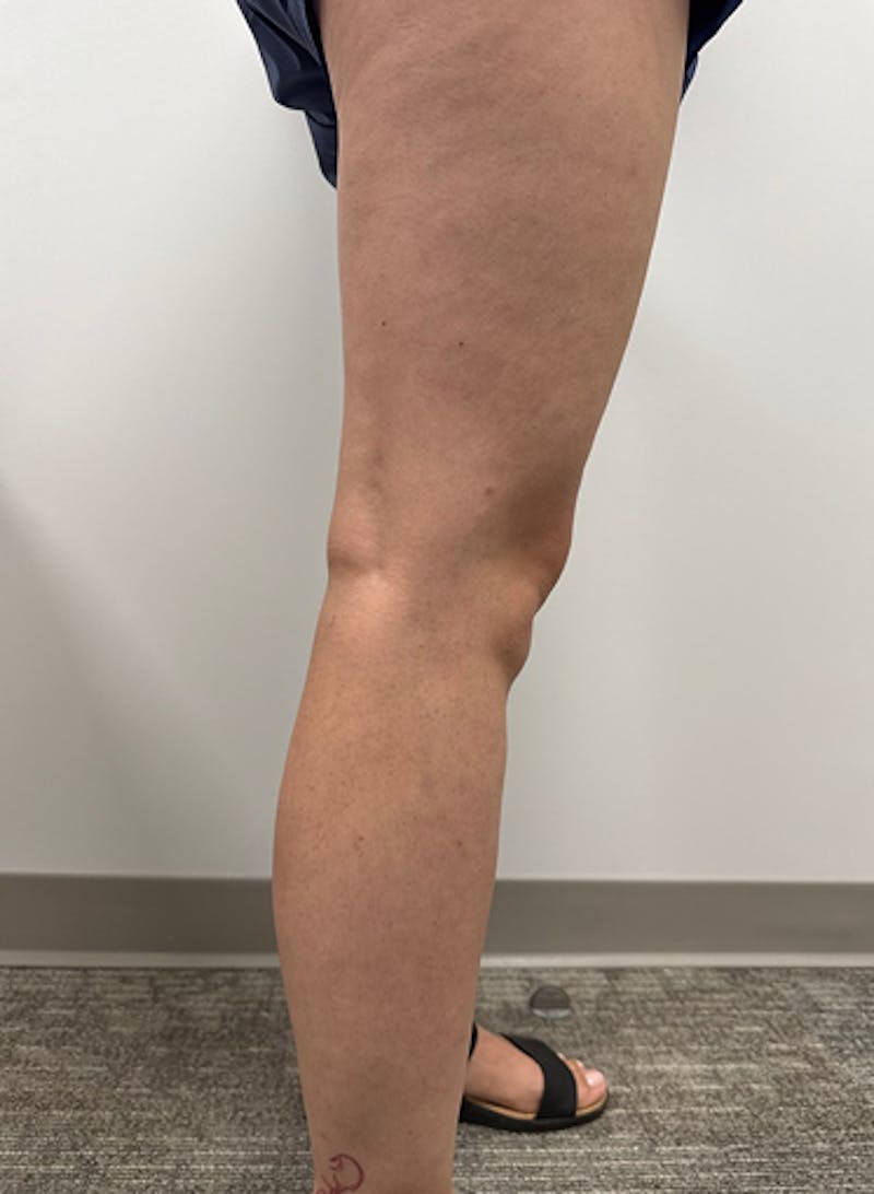 Varithena Treatment Before & After Gallery - Patient 128046 - Image 7