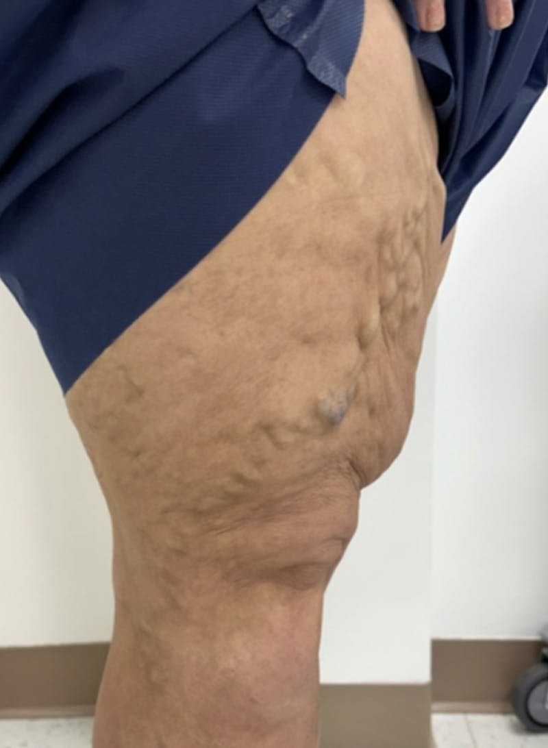 Combination Radio Frequency Ablation and Varithena Before & After Gallery - Patient 155874 - Image 1