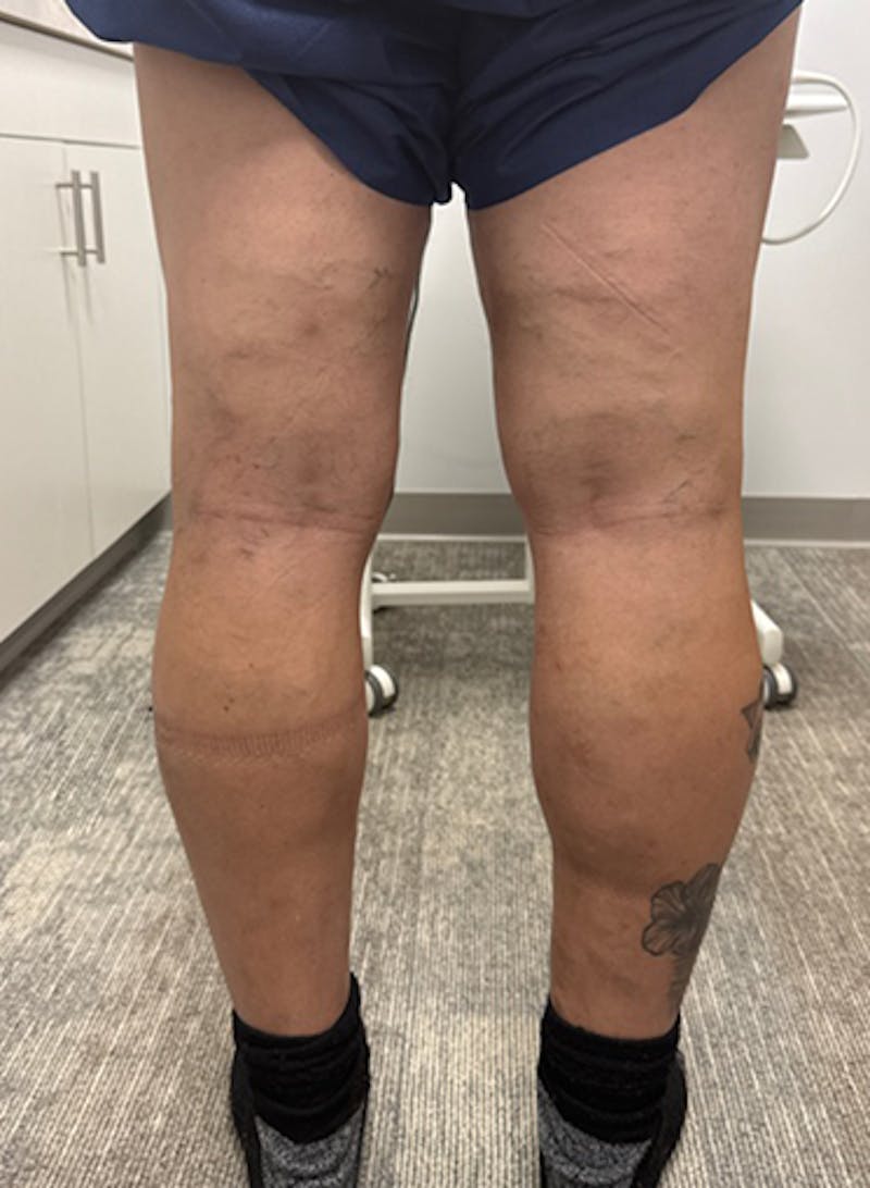 Varithena Treatment Before & After Gallery - Patient 325442 - Image 6