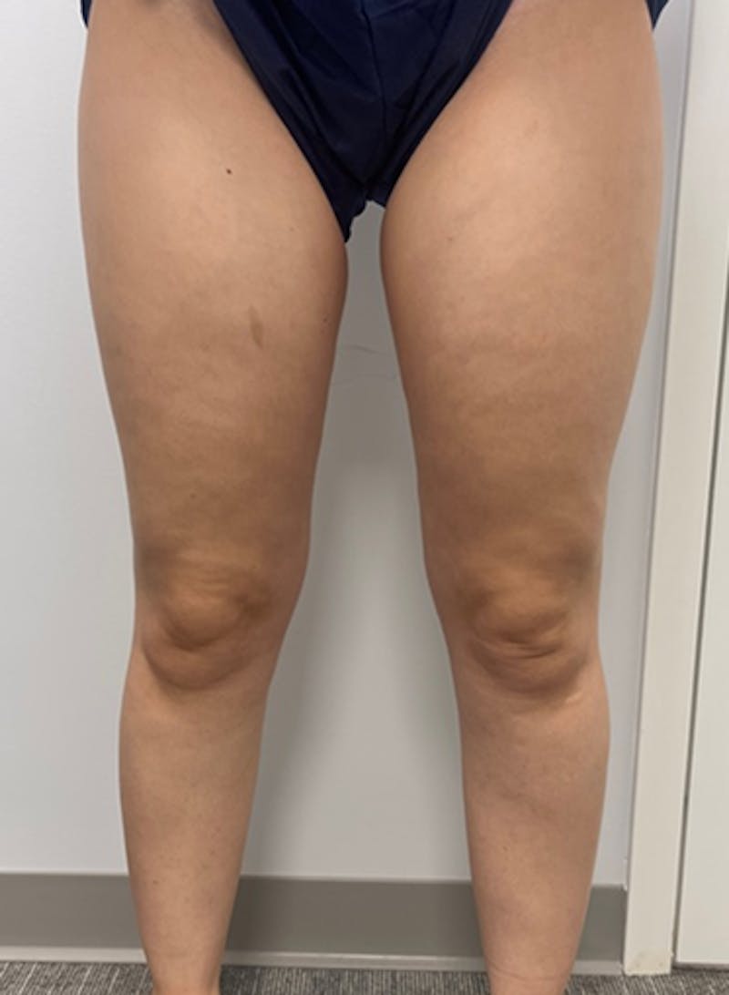 Varithena Treatment Before & After Gallery - Patient 128046 - Image 2