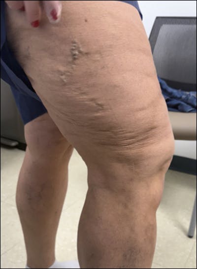 Combination Radio Frequency Ablation and Varithena Before & After Gallery - Patient 155874 - Image 2