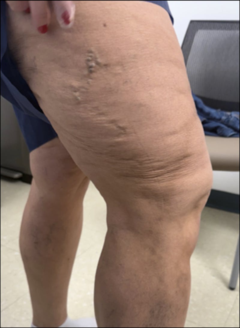 Combination Radio Frequency Ablation and Varithena Before & After Gallery - Patient 155874 - Image 2