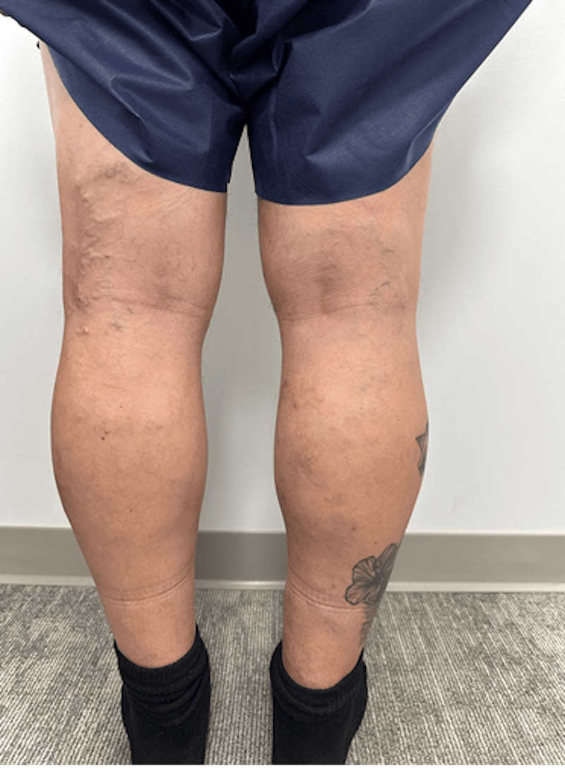 Varithena Treatment Before & After Gallery - Patient 325442 - Image 5