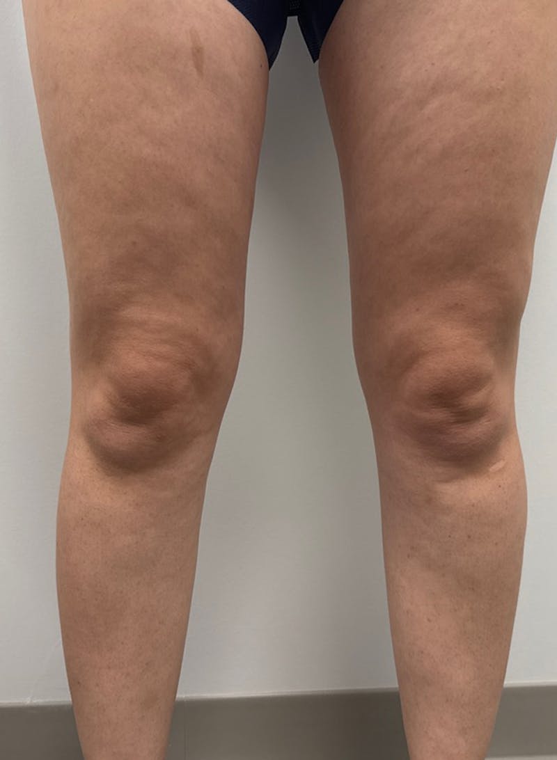 Varithena Treatment Before & After Gallery - Patient 128046 - Image 1